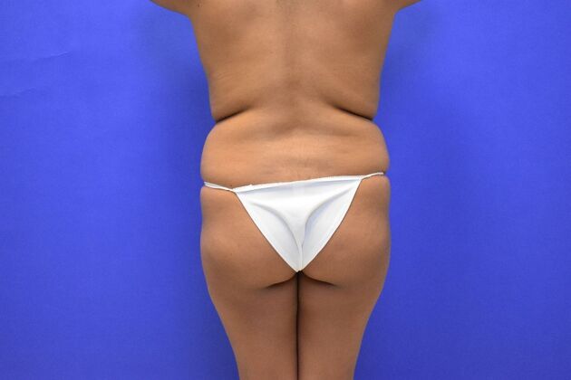 Brazilian Butt Lift (Augmentation) Case 15 - Before