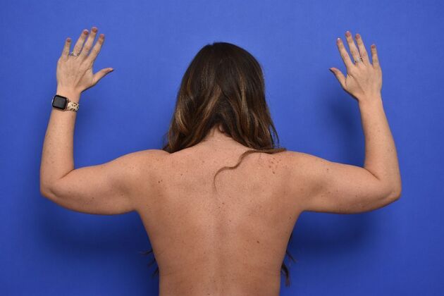 No-incision Arm Lift (lipo and bodytite) Case 6 - Before