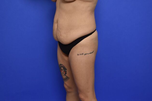 Massive Weight Loss patients: Case 3 - Before