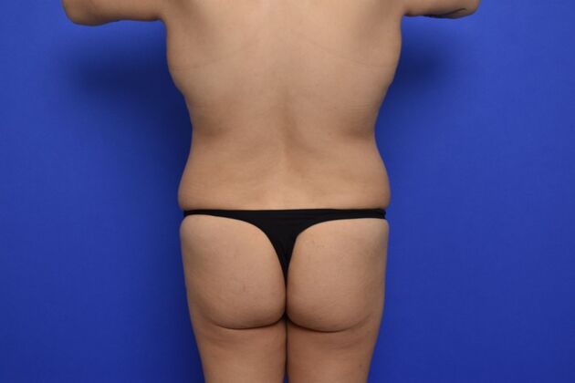 Massive Weight Loss patients: Case 3 - Before