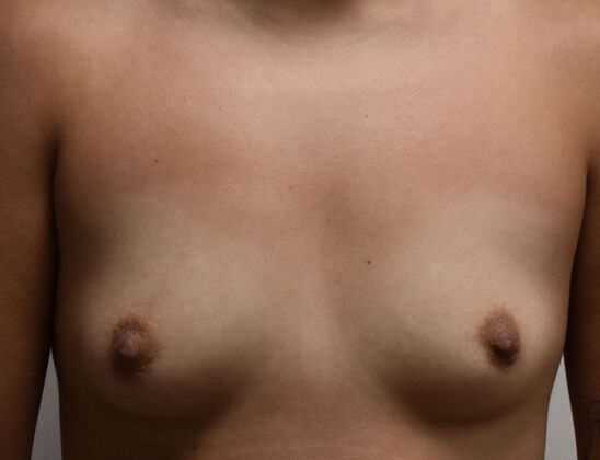 Breast Augmentation Case 838 - Before