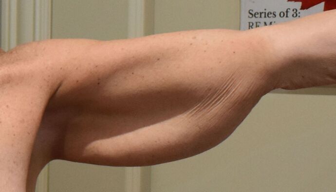 Brachioplasty Case 2 - Before