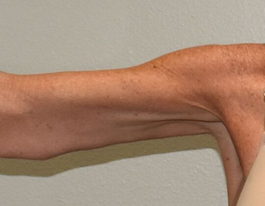 Brachioplasty: Case 2 - After
