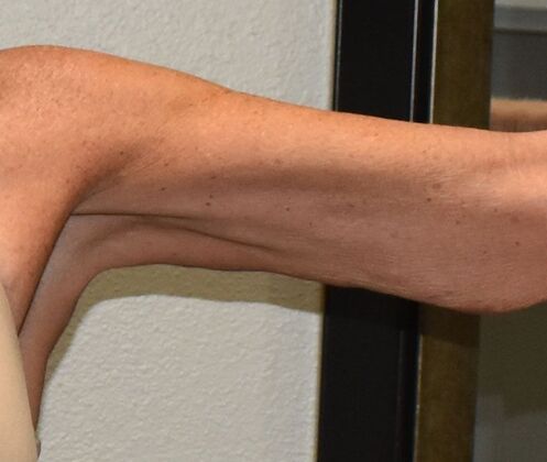 Brachioplasty Case 2 - After