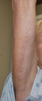 Brachioplasty: Case 2 - After