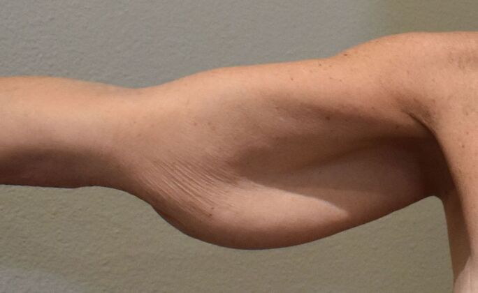 Brachioplasty: Case 2 - Before