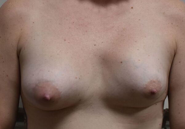 Breast Revision: Case 14 - Before
