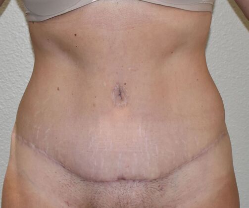 Tummy Tuck (Abdominoplasty): Case 30a - After