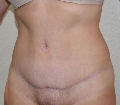 Tummy Tuck (Abdominoplasty): Case 30a - After