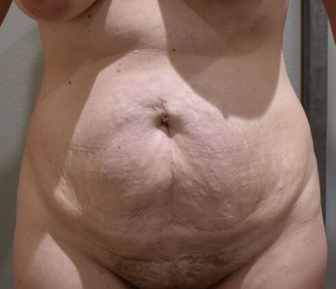Tummy Tuck (Abdominoplasty): Case 30a - Before
