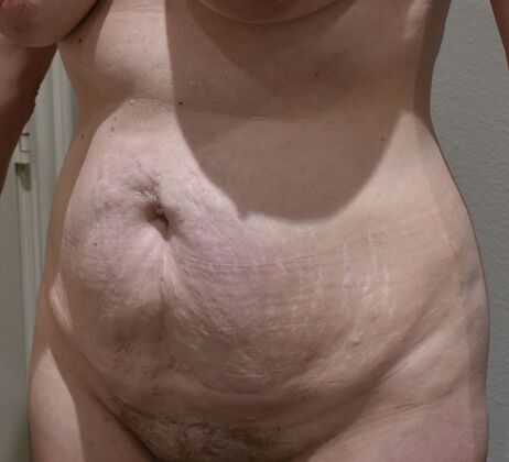 Tummy Tuck (Abdominoplasty): Case 30a - Before