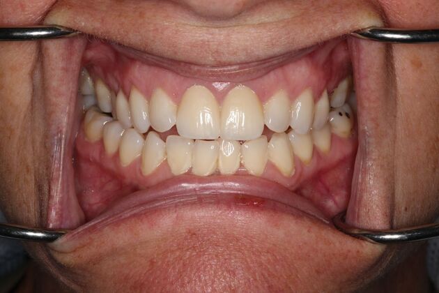 Dental Crowns & Veneers: Case 3 - After