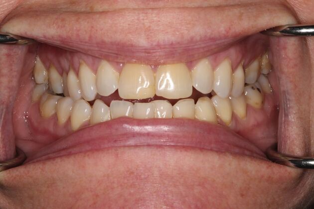 Teeth Whitening: Case 2 - Before