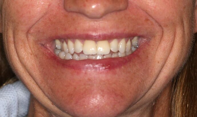 Teeth Whitening Case 2