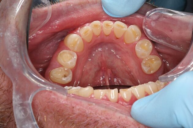 Full Mouth Reconstruction: Case 6 - Before