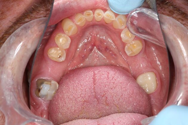 Full Mouth Reconstruction: Case 6 - Before