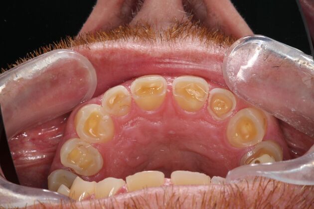 Full Mouth Reconstruction: Case 6 - Before