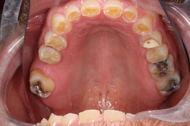 Full Mouth Reconstruction: Case 6 - Before
