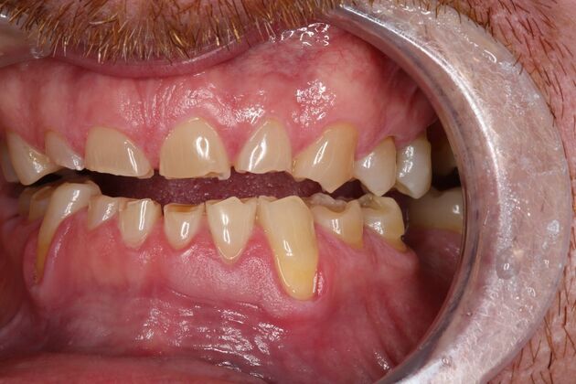 Full Mouth Reconstruction: Case 6 - Before