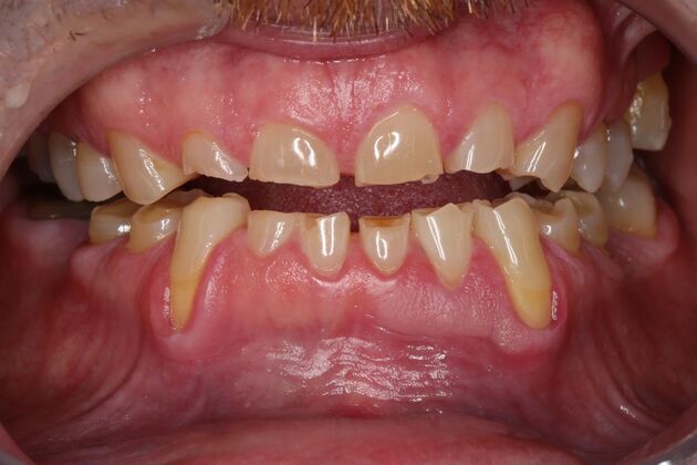 Full Mouth Reconstruction: Case 6 - Before