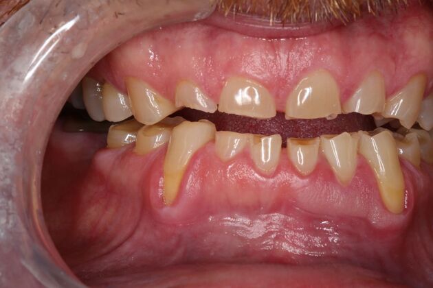 Full Mouth Reconstruction: Case 6 - Before