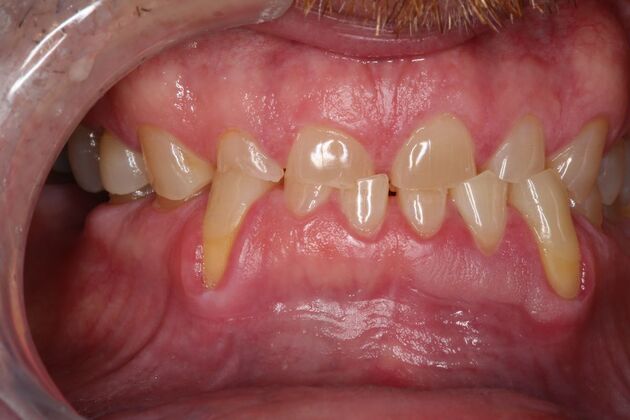 Full Mouth Reconstruction: Case 6 - Before