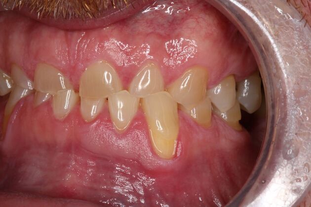 Full Mouth Reconstruction: Case 6 - Before