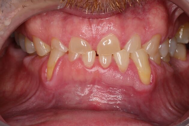 Full Mouth Reconstruction Case 6 - Before