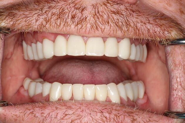 Full Mouth Reconstruction: Case 6 - After