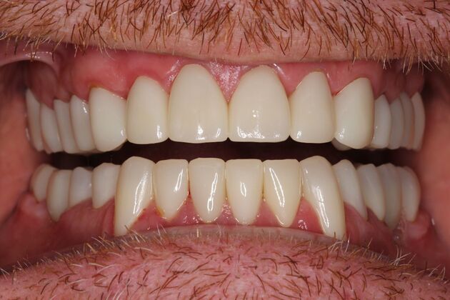 Full Mouth Reconstruction: Case 6 - After
