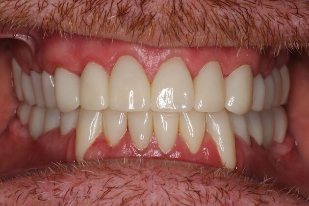 Full Mouth Reconstruction: Case 6 - After