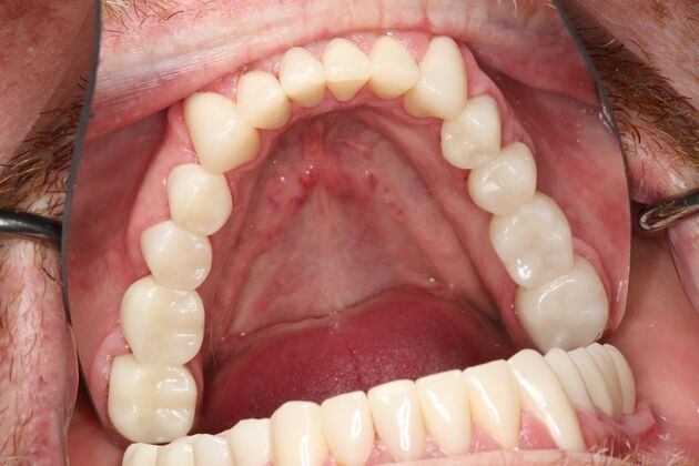 Full Mouth Reconstruction: Case 6 - After