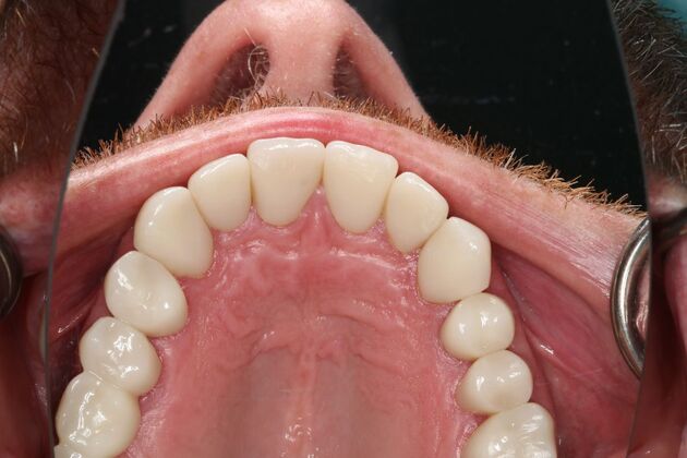 Full Mouth Reconstruction: Case 6 - After