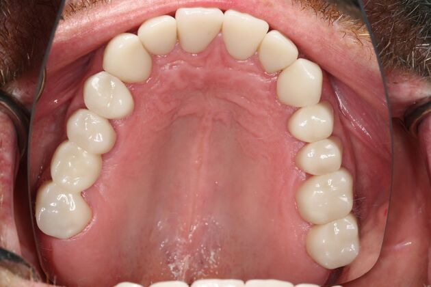Full Mouth Reconstruction: Case 6 - After