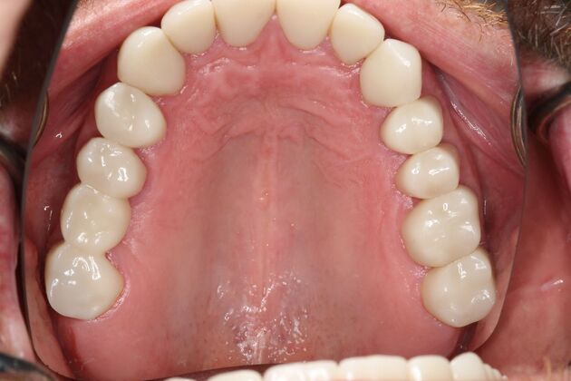 Full Mouth Reconstruction: Case 6 - After - Top