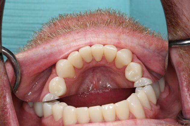 Full Mouth Reconstruction: Case 6 - After
