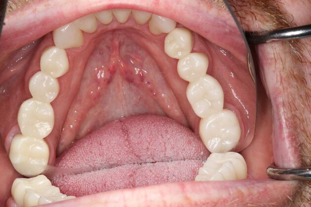 Full Mouth Reconstruction: Case 6 - After - Bottom