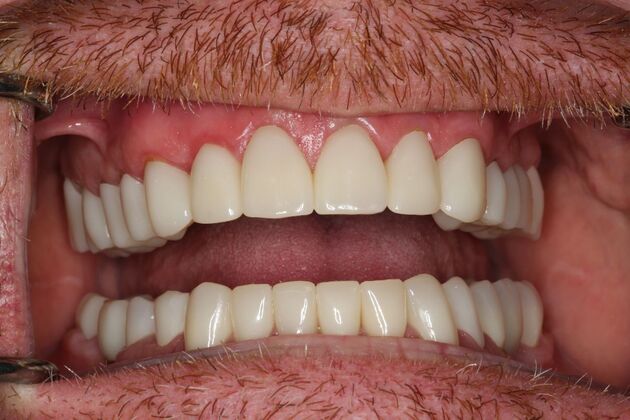 Full Mouth Reconstruction: Case 6 - After