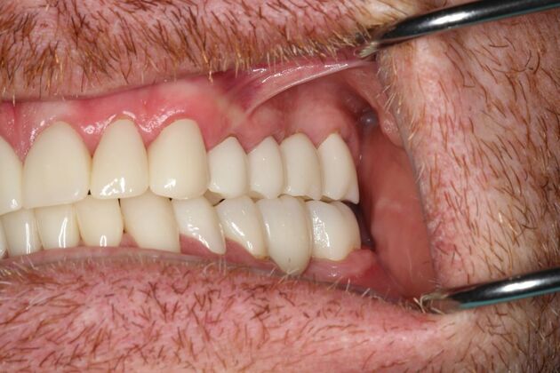 Full Mouth Reconstruction: Case 6 - After