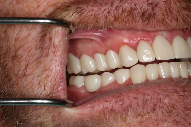 Full Mouth Reconstruction: Case 6 - After