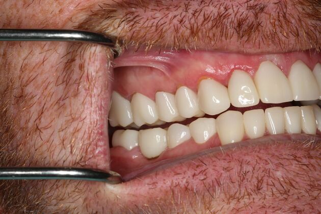 Full Mouth Reconstruction: Case 6 - After