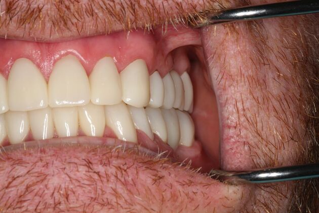 Full Mouth Reconstruction: Case 6 - After