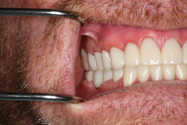 Full Mouth Reconstruction: Case 6 - After