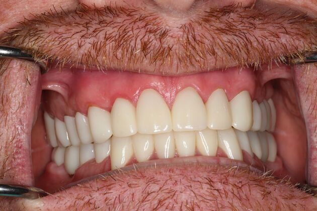 Full Mouth Reconstruction: Case 6 - After