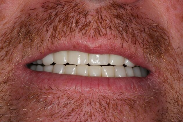 Full Mouth Reconstruction: Case 6 - After