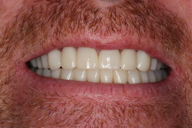Full Mouth Reconstruction Case 6 - After