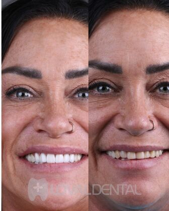 Ceramic Veneers  Veneers Case