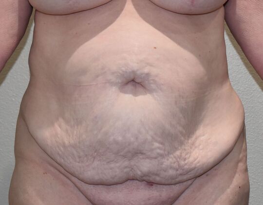 Tummy Tuck (Abdominoplasty): Case 615 - Before