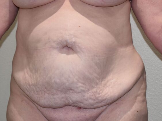 Tummy Tuck (Abdominoplasty): Case 615 - Before