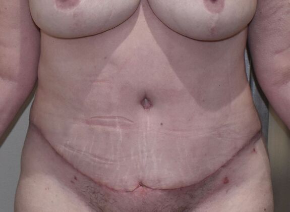 Tummy Tuck (Abdominoplasty): Case 615 - After
